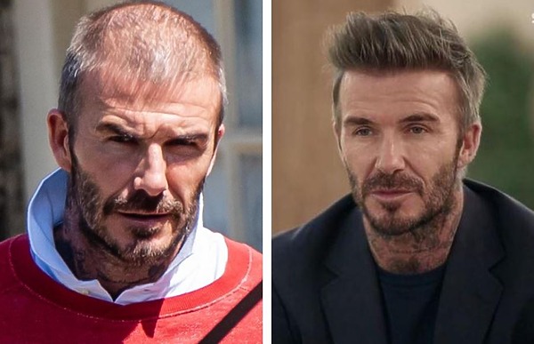 david beckham hair transplant before and after
