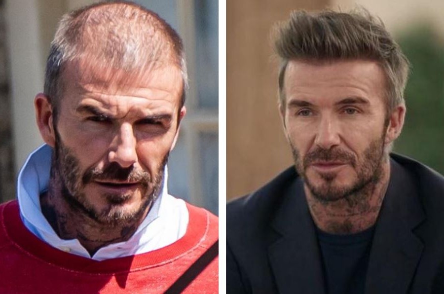 David Beckham Hair Transplant Before And After
