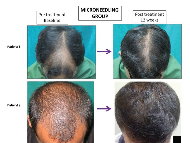 Before and after photos of two patients who used micro-needling combined with Minoxidil treatment