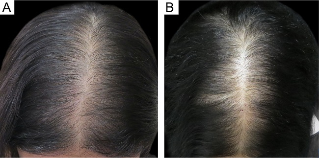 Before and after derma-rolling treatments in a patient with diffuse thinning