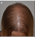 diffuse alopecia areata