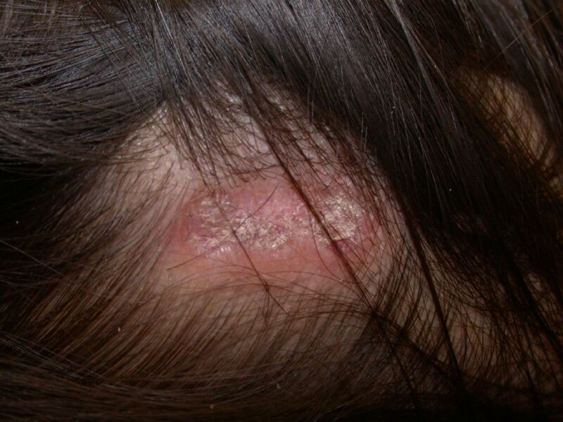 disc shaped lesion caused by lupus