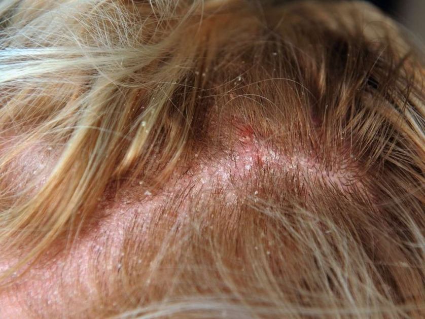 Scabs On Scalp: Everything You Need To Know - Wimpole Clinic