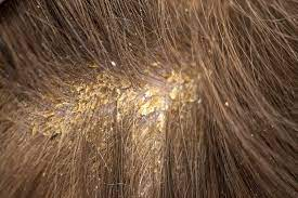 diseased scalp