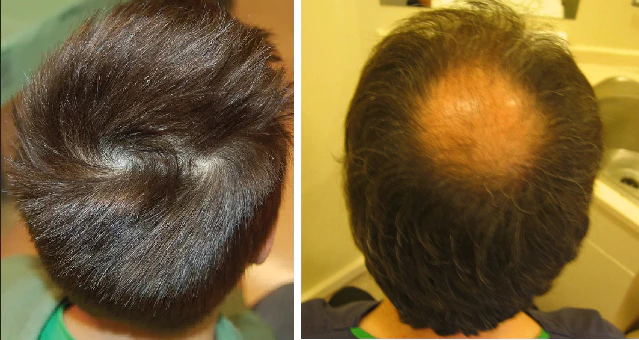 Left: example of double crown. Right: crown hair loss characteristic of male pattern baldness.