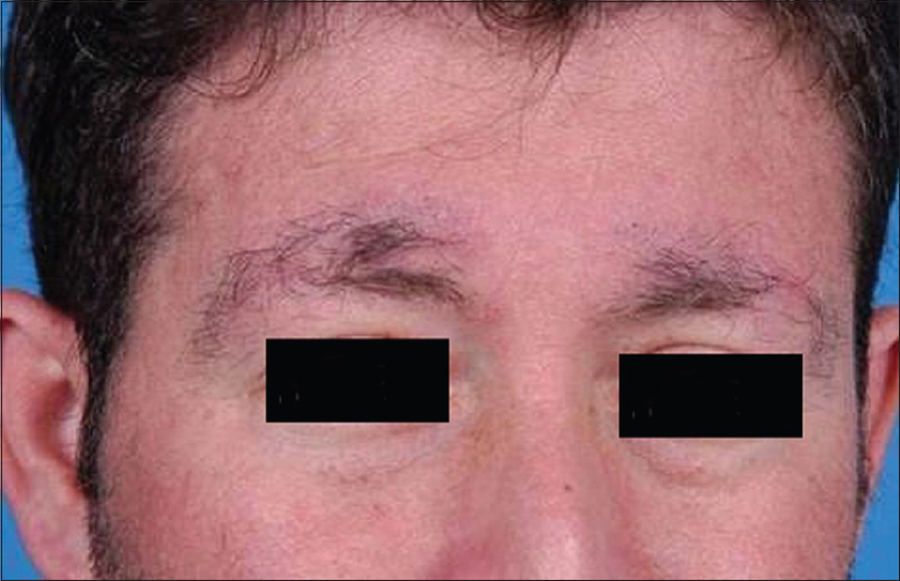 Patient with double eyebrows