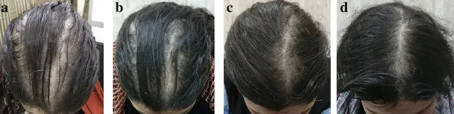 Increased hair density due to the use of 2% Minoxidil everyday