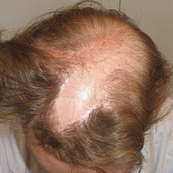 juri flap scars from scalp reduction surgery