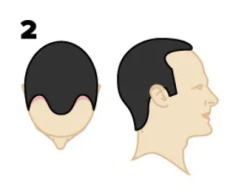 Illustrated example of Norwood 2 stage of hair loss