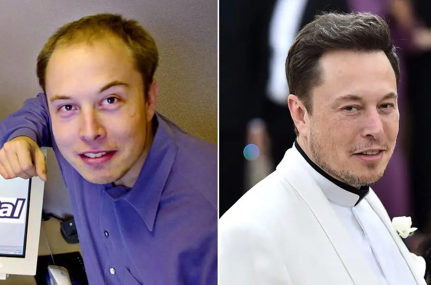 Elon Musk with receding hairline (left) and fully restored hairline (right)