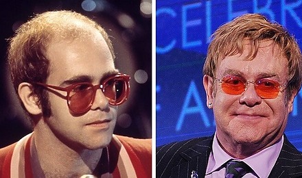 Elton John Before And After Hair Transplant