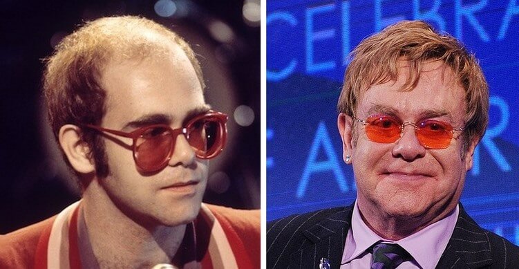 Elton John before and after multiple hair transplant surgeries