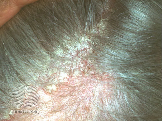 example of scalp symptoms of atopic dermatitis