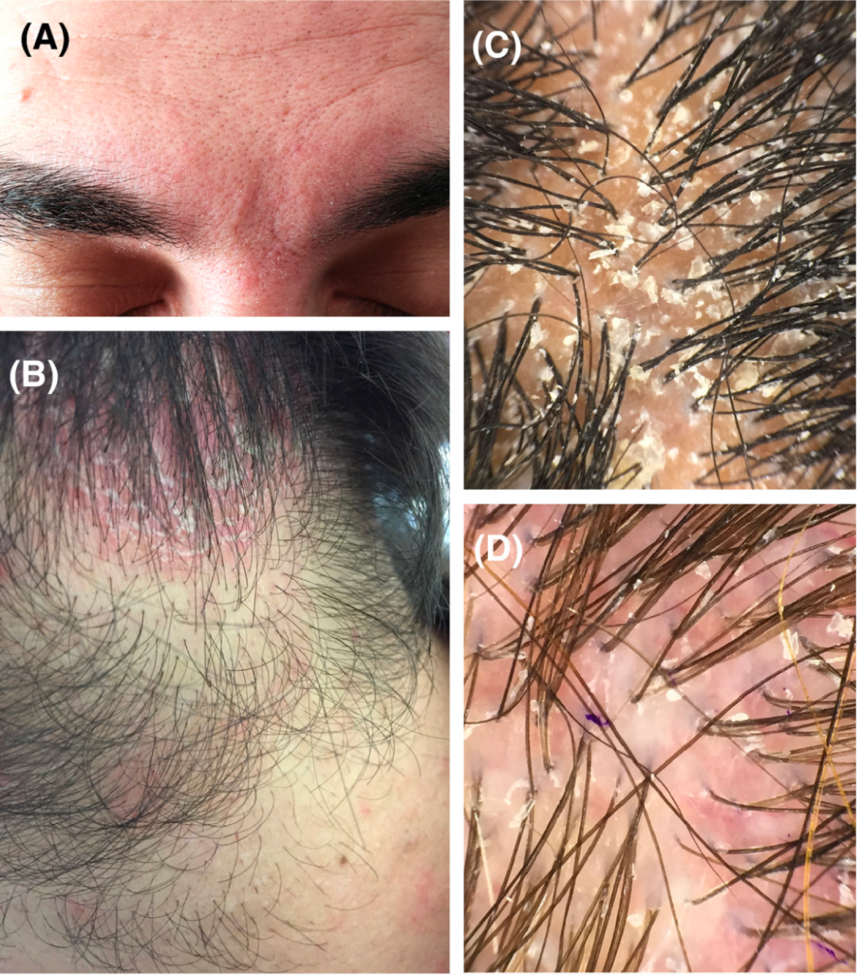 example of scalp symptoms of dandruff