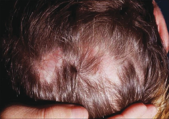 Hair Loss After Surgery: Why It Happens & How To Stop It