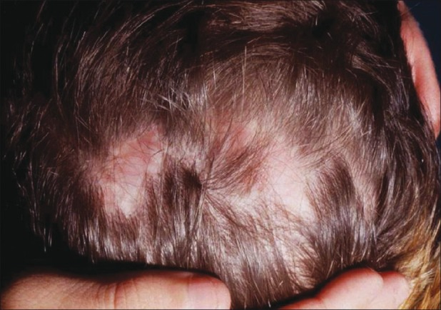 example of scarring alopecia