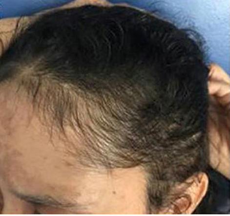 example of temple hair loss due to telogen effluvium