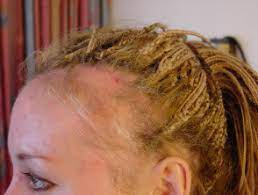 example of traction alopecia caused by tight hairstyles