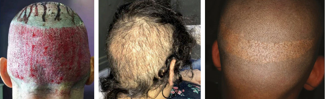 Examples of hair transplant overharvesting