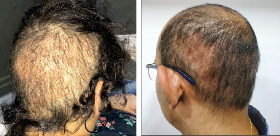examples of overharvesting from a bad hair transplant
