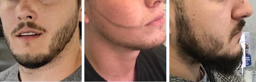 examples of patchy beards