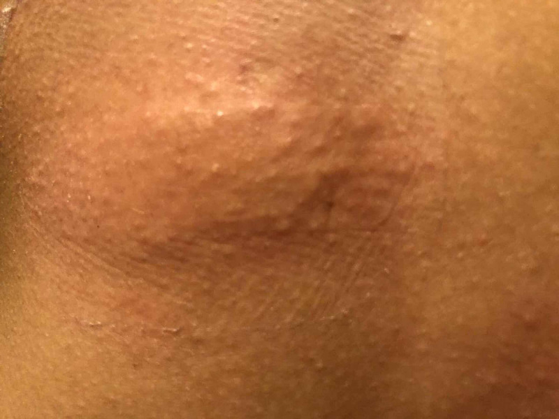 example of swelling and rash due to the use of Minoxidil foam