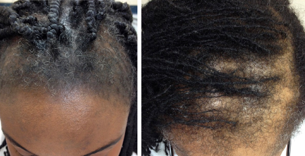examples of traction alopecia