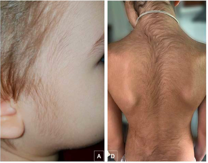 excessive facial and body hair in children