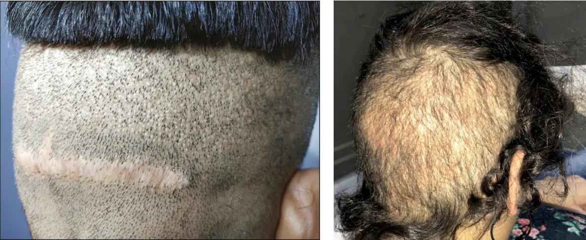 5 Hair Transplant Regrets (And How To Avoid Them), Wimpole Clinic