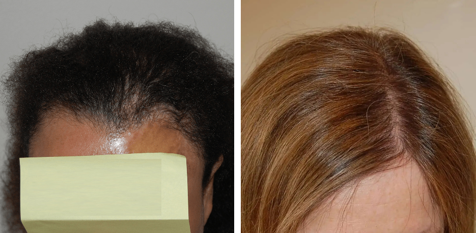 female hair transplant results