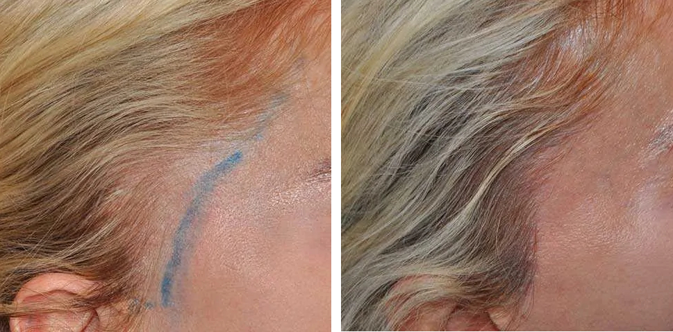 female patient before and after 500 grafts transplant