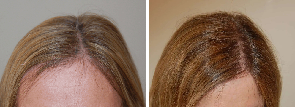 female patient before and after 500 grafts transplantation