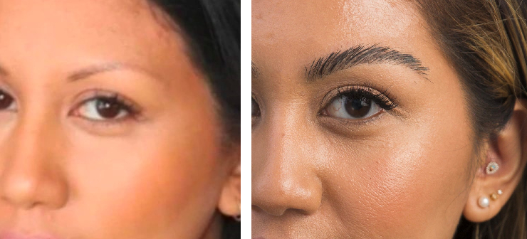 female patient before and after eyebrow hair transplant surgery