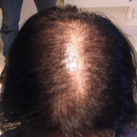 female pattern baldness example