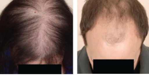 female pattern baldness (left) vs male pattern baldness (right)
