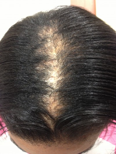 Central centrifugal cicatricial alopecia (CCCA) hair loss 1