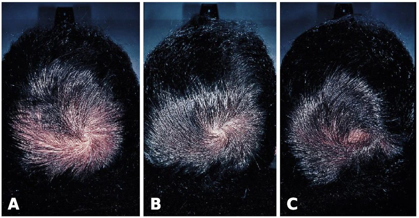 Hair growth results from using Finasteride to treat male pattern hair loss at baseline (A), 12 months (B), and 24 months (C)