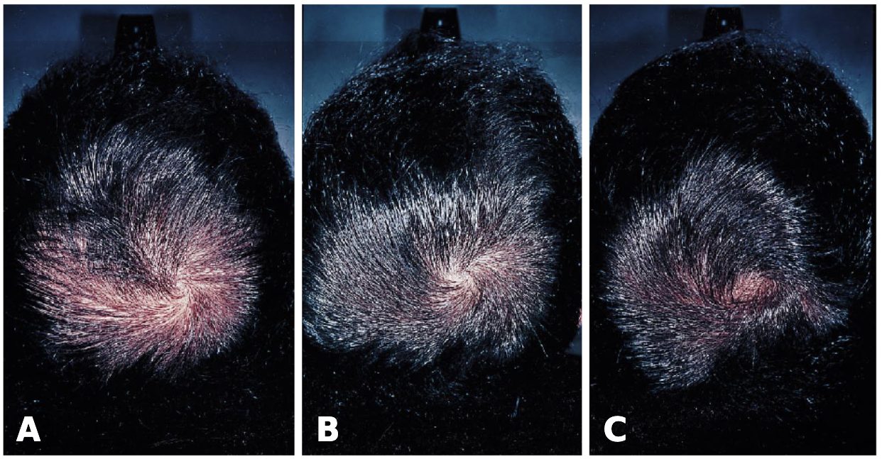 finasteride patient results at baseline, 12months, 24months
