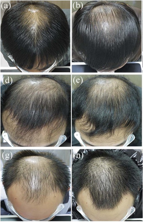 Finasteride Results: Timeline, Photos, Before & After