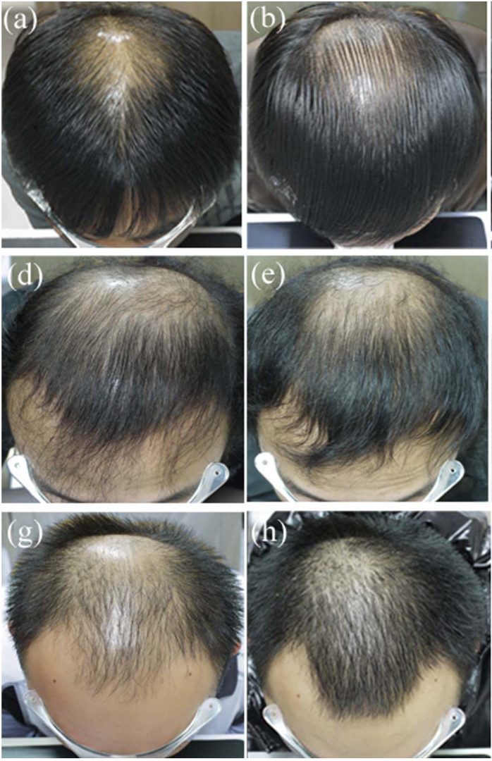 Finasteride results after 6 months of treatment