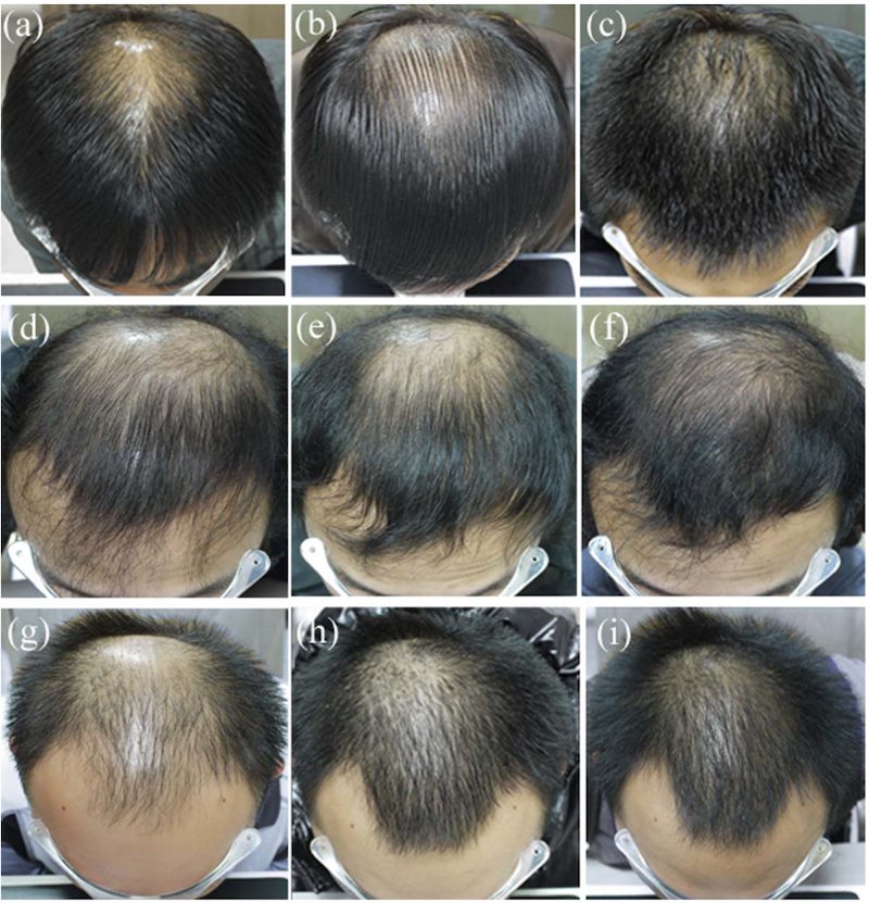 finasteride results before treatment and at 6 and 12 month intervals