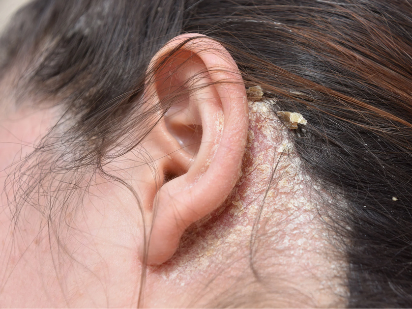 Yeast Infection on Scalp Expert Review of Causes, Symptoms and