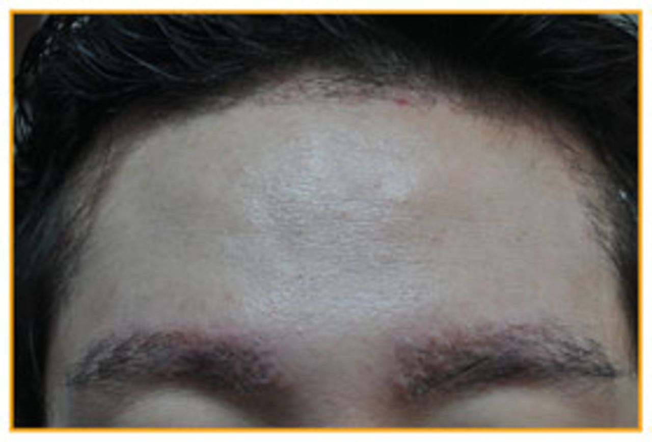 folliculitis after eyebrow hair transplant