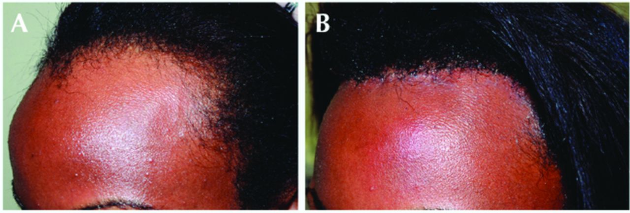 Before and after results of forehead reduction surgery