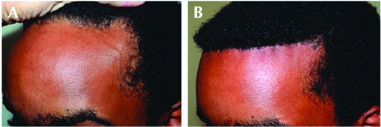 forehead reduction surgery before and after 2