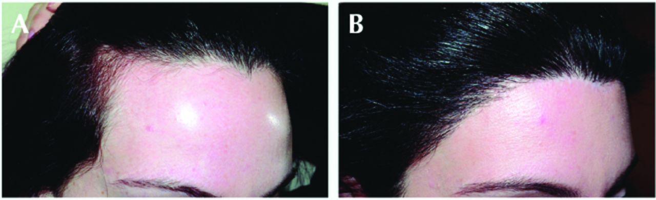 Patient before and after forehead reduction surgery