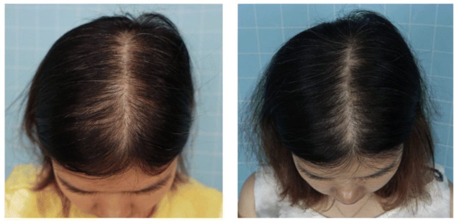 Before and after topical Minoxidil results in a female patient
