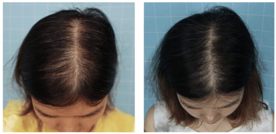 Before and after results of using topical treatment of Minoxidil in a female patient