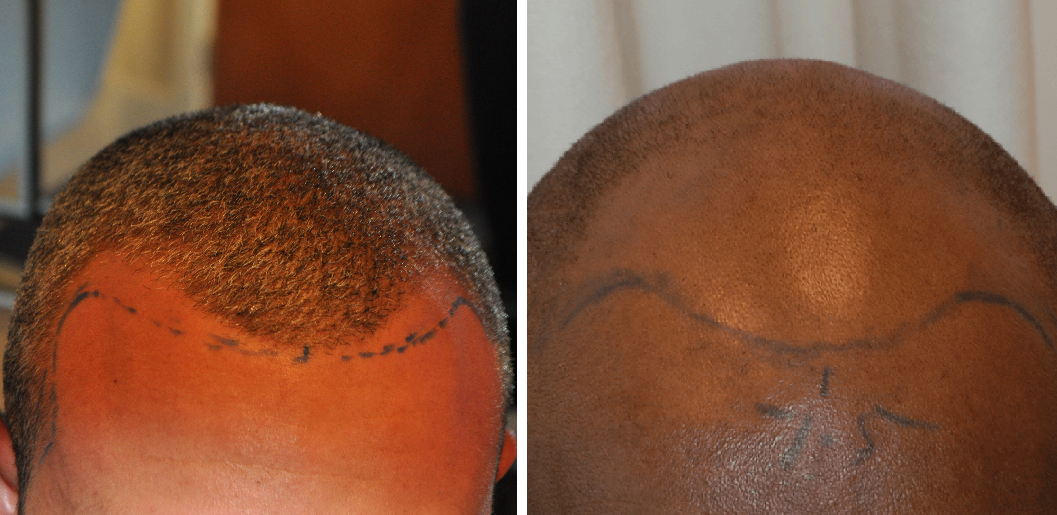 Examples of front baldness caused by androgenic alopecia