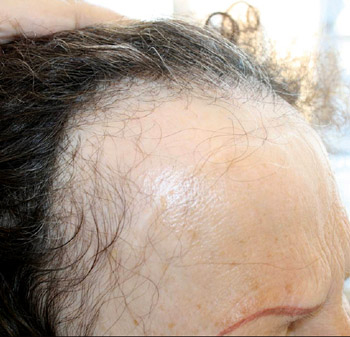 frontal balding due to frontal fibrosing alopecia